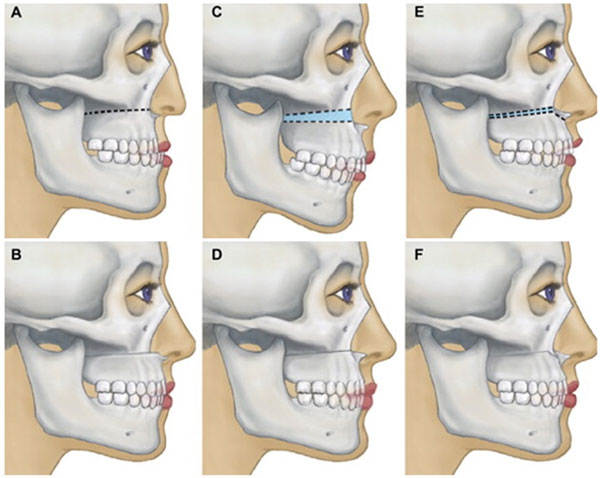 Phẫu thuật hàm được áp dụng đối với sai lệch khớp cắn do hàm