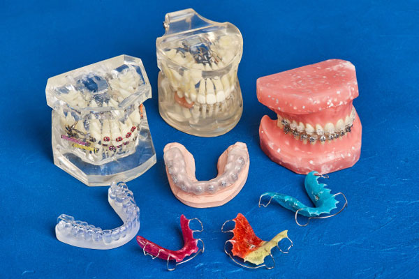 Có rất nhiều phương pháp niềng răng và mỗi loại sẽ có những ưu điểm, nhược điểm riêng