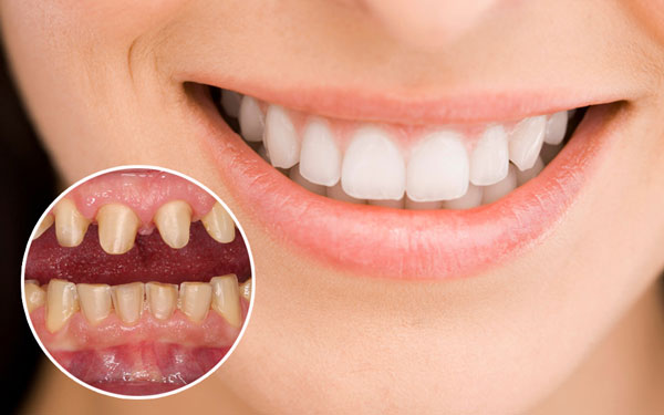 Bọc răng sứ giúp phục hình thẩm mỹ và cải thiện chức năng của răng bằng việc sử dụng mão sứ bao bọc bên ngoài răng thật đã được mài mòn