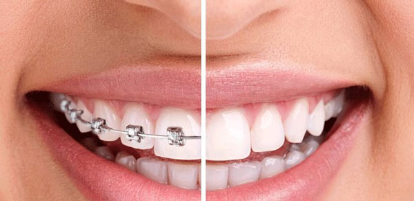 Niềng răng và bọc răng sứ có gì khác biệt?