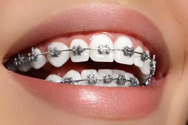 Bảo vệ kết quả niềng răng