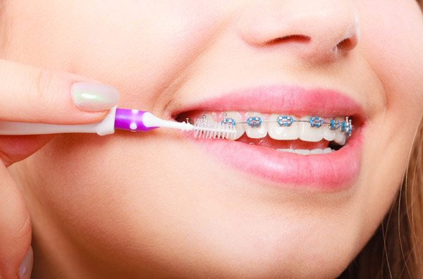 Cách vệ sinh răng miệng khi niềng răng
