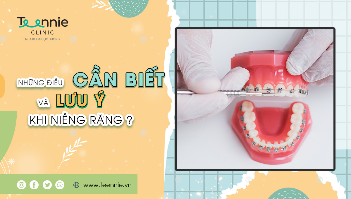 Những điều Cần Biết Và Lưu ý Khi Niềng Răng 0365