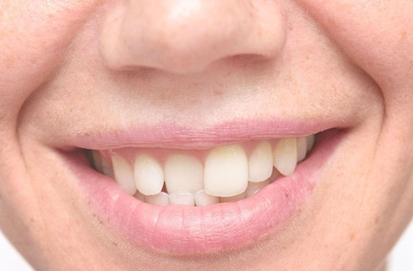 Nếu trong cả hàm răng chỉ bị 1 cái lệch so với những chiếc còn lại thì chỉ niềng 1 cái răng được không?