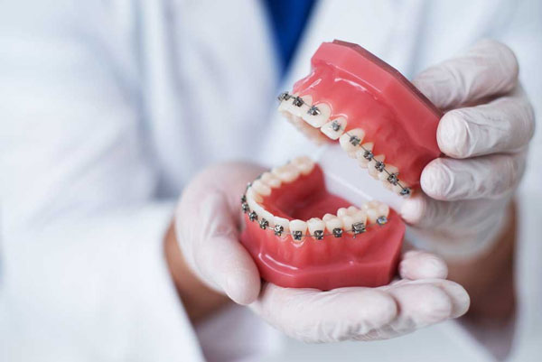Niềng răng là một kỹ thuật nha khoa, được sử dụng để khắc phục các trường hợp răng, hàm sai lệch