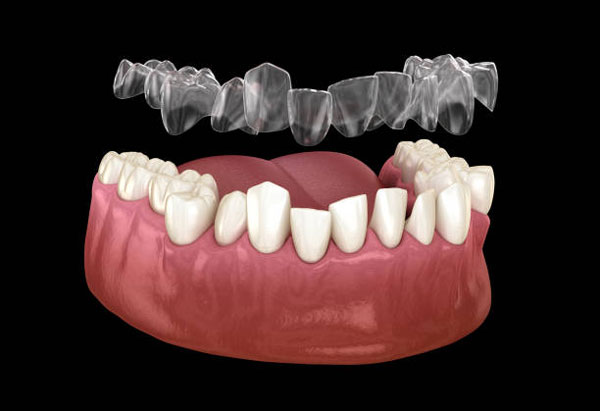 Niềng răng 3D Clear Aligner phù hợp với nhiều trường hợp hô, móm, thưa, khấp khểnh,...