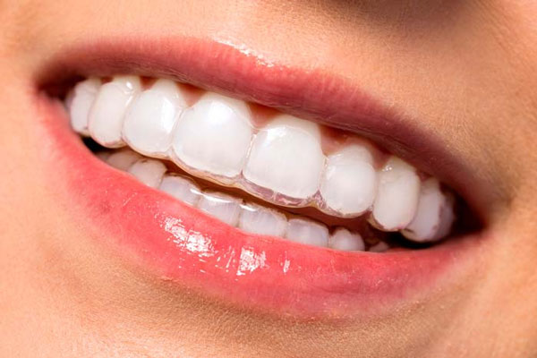 Niềng răng 3D Clear Aligner mang lại hiệu quả với những trường hợp răng sai lệch nhẹ