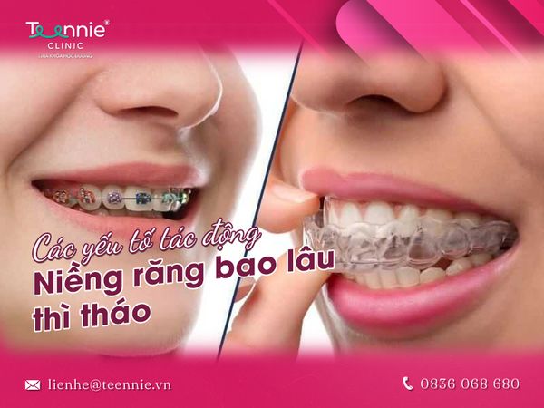 Bạn có biết thời gian niềng răng bao lâu thì tháo niềng?