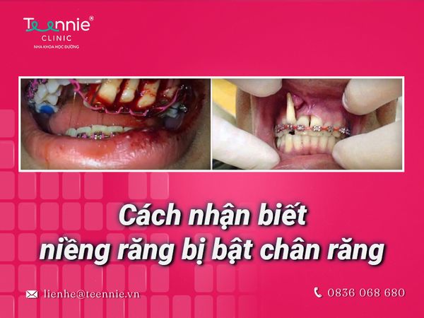 Cùng Teenie giải đáp thắc mắc niềng răng bị bật chân răng hay không?