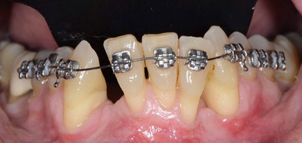 Nguyên nhân niềng răng bị tụt lợi có thể do mảng bám cao răng, do bệnh lý của răng hay do cơ chế cung dây siết lực mạnh trên răng,...