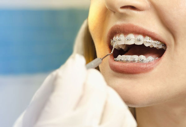 Niềng răng bị tụt lợi ở mức độ nặng bạn nên đến thăm khám tại nha khoa để bác sĩ kiểm tra, tư vấn