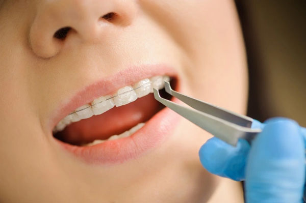 Niềng răng mắc cài sứ được chế tạo từ vật liệu sứ cao cấp mang đến sự thẩm mỹ cao