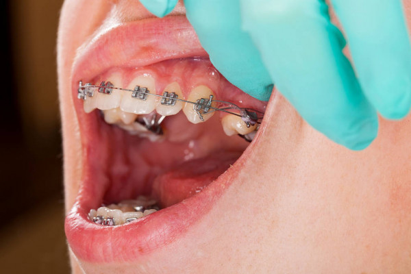 Không điều trị bệnh lý trước khi niềng răng, không tuân thủ chỉ dẫn của bác sĩ,... là những nguyên nhân hàng dầu dẫn đến tình trạng niềng răng bị hở lợi
