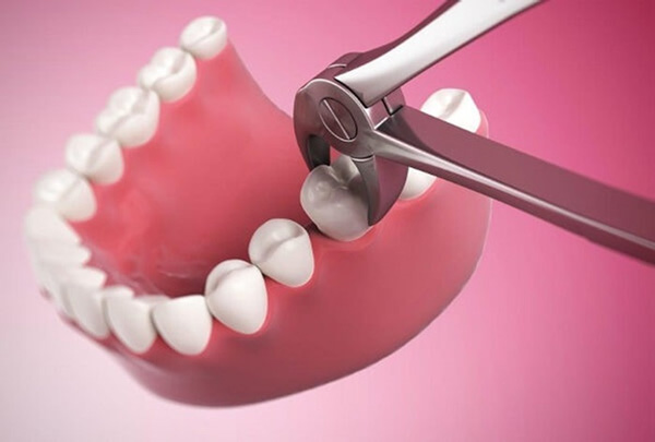 Tại sao phải nhổ răng khi niềng răng