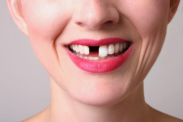 Niềng răng không nhổ bất kỳ răng nào khi bạn thiếu răng bẩm sinh