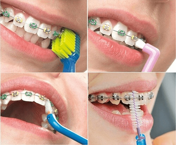 Đối với những người niềng răng, việc vệ sinh răng miệng cực kỳ quan trọng.