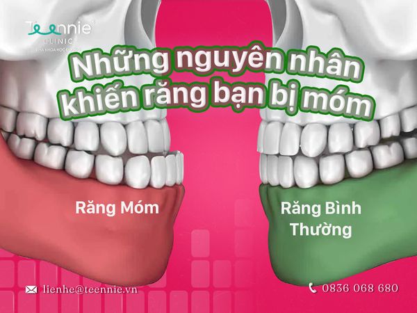 Niềng răng có đắt không trong trường hợp khắc phục răng bị móm?