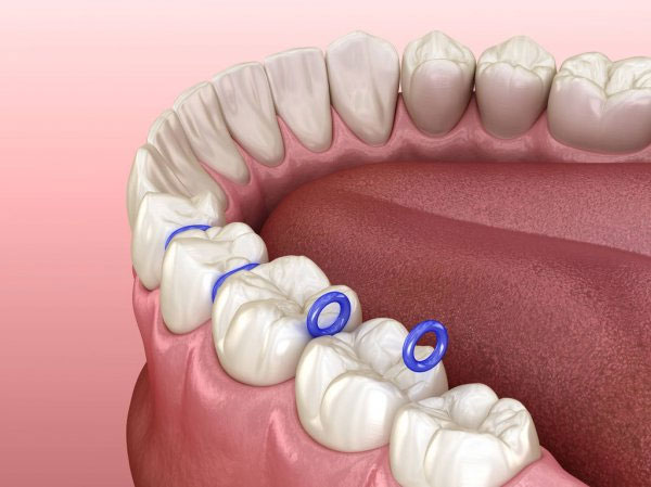 Đau nhức nhẹ ở giai đoạn đặt thun tách kẽ khi niềng răng
