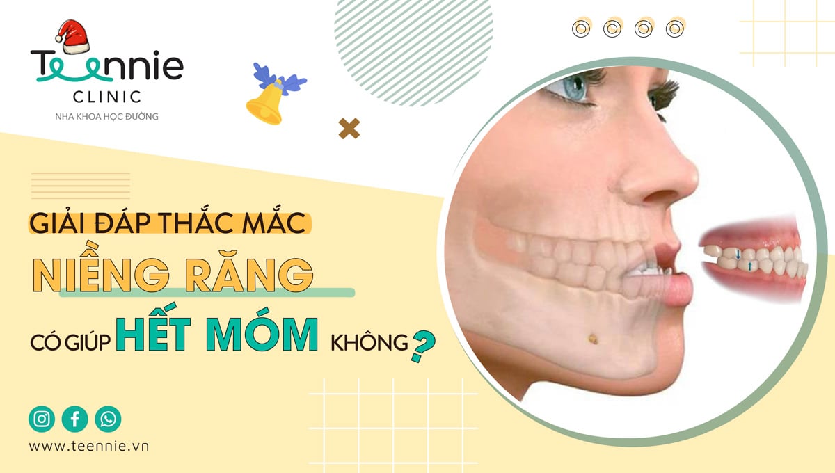 Giải đáp thắc mắc niềng răng có giúp hết móm không?