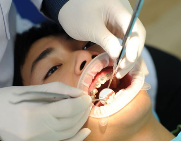Răng bị yếu đi sau khi niềng xuất phát từ nhiều nguyên nhân