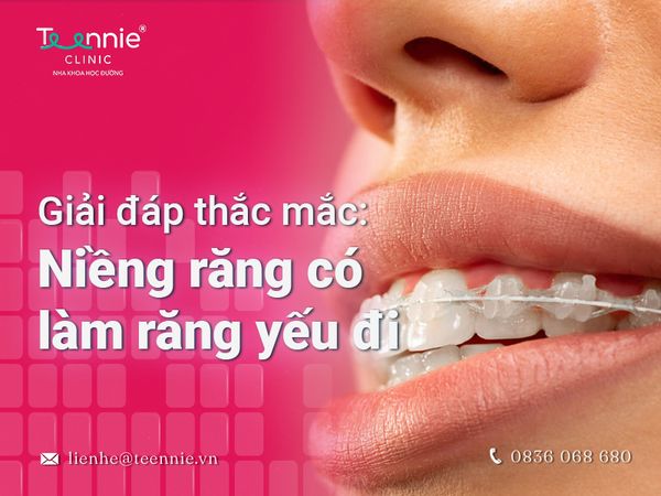 Niềng răng có làm răng yếu đi hay không? Phương hướng xử lý khi răng bị yếu đi