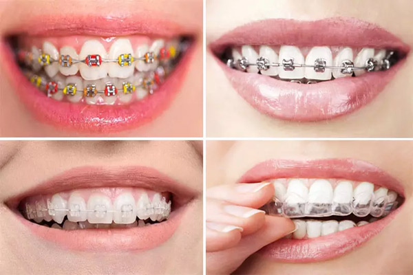 Phương pháp niềng răng là gì? Những lợi ích của niềng răng