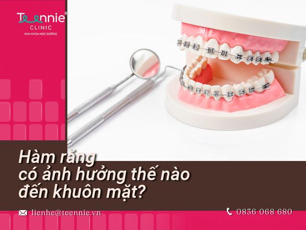 Niềng răng giúp mặt thon gọn hay không? Những sự thay đổi của khuôn mặt sau khi niềng răng