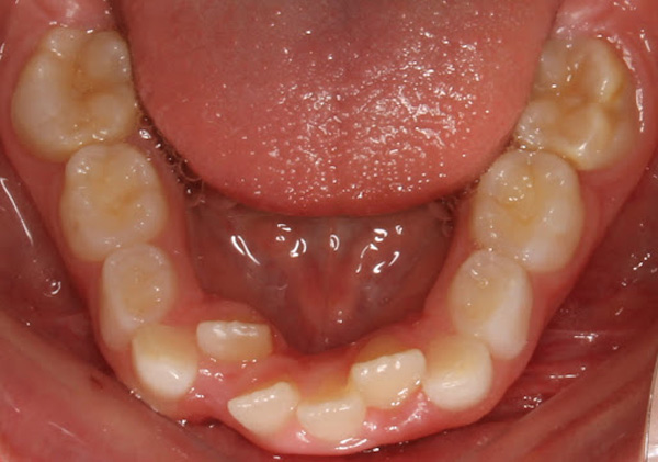 Những trường hợp có thể niềng răng hàm dưới