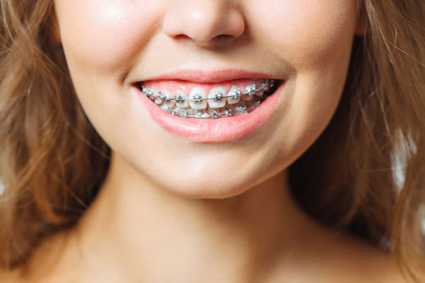 Nha sĩ khuyên bạn nên niềng cả hai hàm để có thể khắc phục các khiếm khuyết răng hàm một cách toàn diện hơn