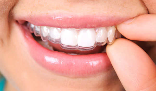Vì sao niềng răng không mắc cài có giá cao hơn so với các phương pháp khác?