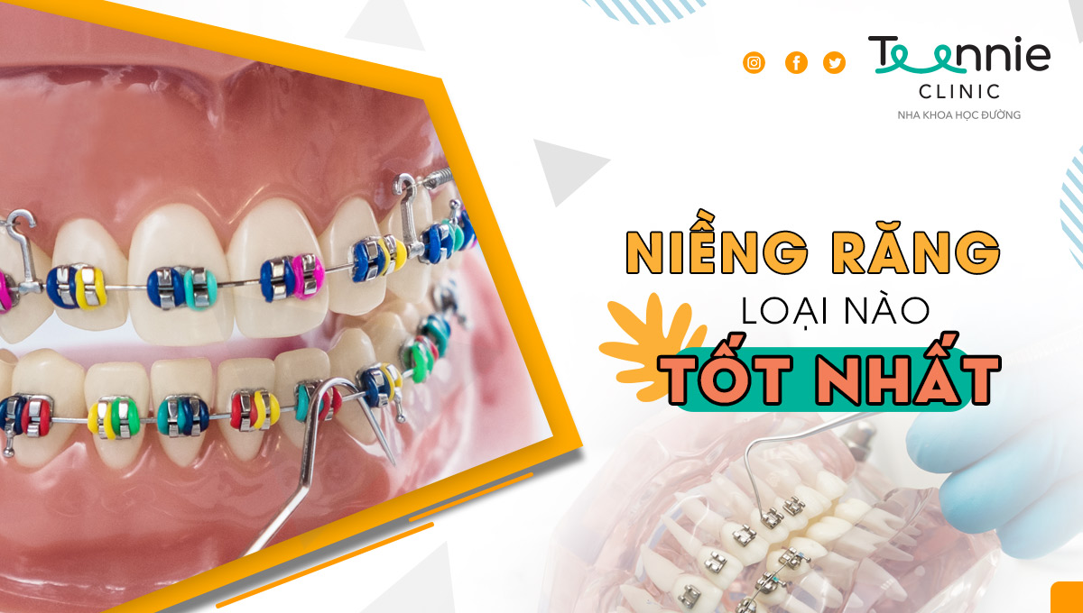 Hiểu rõ niềng răng loại nào tốt nhất hiện nay mà bạn nên biết?