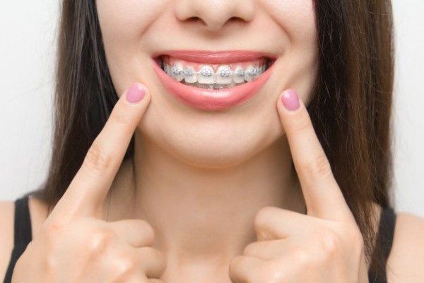 Niềng răng mắc cài kim loại có ưu và nhược điểm riêng biệt