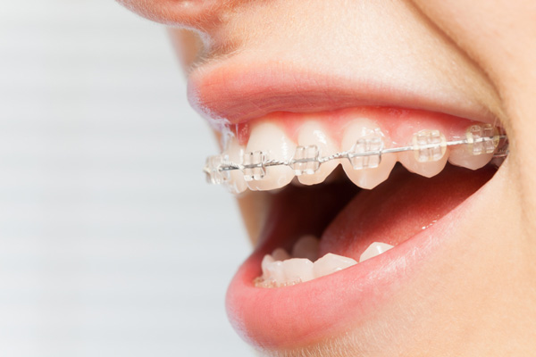 Niềng răng mắc cài sứ có ưu và nhược điểm riêng biệt