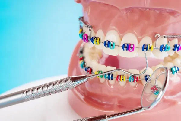 Phương pháp niềng răng mắc cài kim loại truyền thống