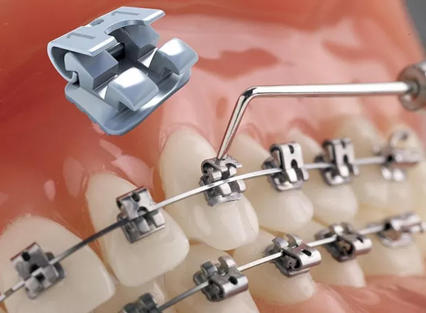 Phương pháp niềng răng mắc cài kim loại tự đóng/ tự khóa