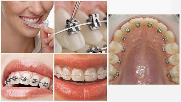 Những yếu tố ảnh hưởng đến chi phí niềng răng mắc cài kim loại