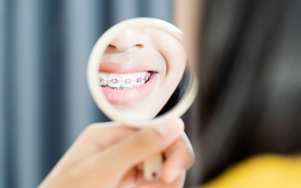 Kỹ thuật niềng răng mắc cài kim loại truyền thống là gì?