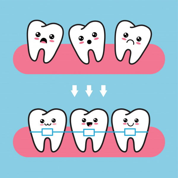 Tại sao cần phải niềng răng mắc cài kim loại truyền thống?