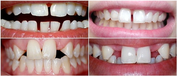 Những tình trạng răng thưa cần khắc phục