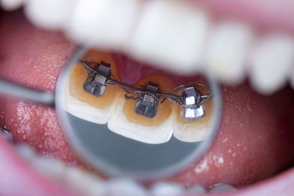 Niềng răng mắc cài mặt trong có chi phí bao nhiêu?