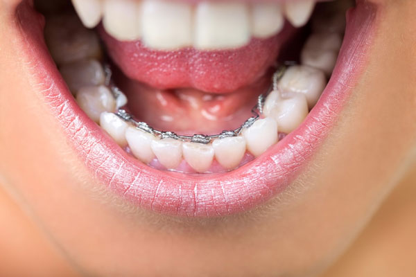 Niềng răng mắc cài mặt trong hay còn gọi là niềng răng mắc cài mặt lưỡi