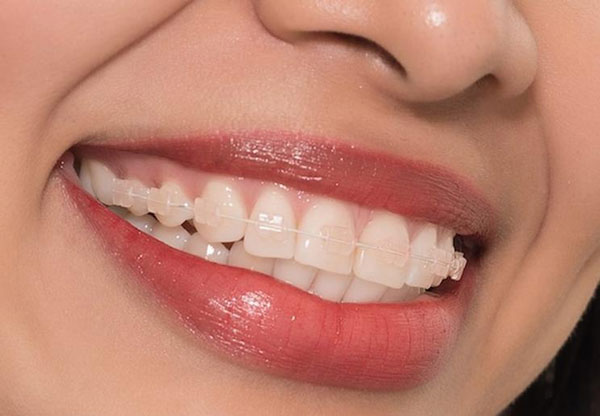 Niềng răng mắc cài pha lê có ưu điểm và hạn chế gì?