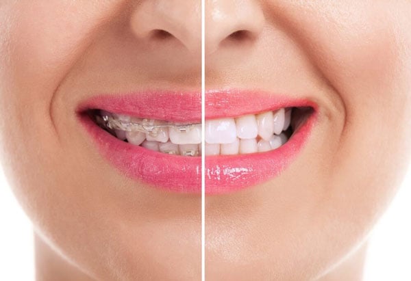 Niềng răng mắc cài sứ giúp răng di chuyển về đúng vị trí trên cung hàm hiệu quả với tính thẩm mỹ cao