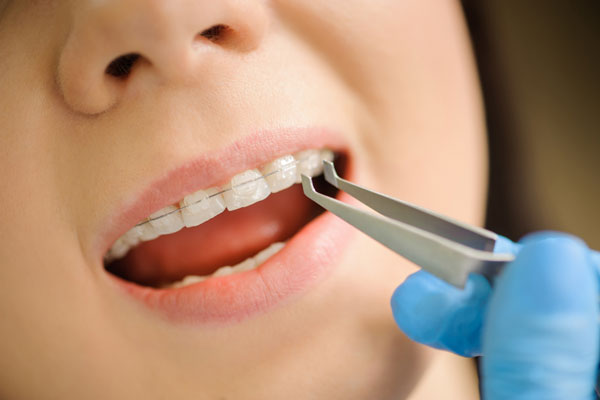 Mắc cài sứ có điểm hạn chế là rất dễ bị vỡ, mẻ so với kim loại nếu tác động lực kéo răng quá lớn