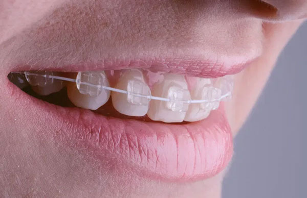 Niềng răng mắc cài sứ dây trong sử dụng hệ thống mắc cài sứ và dây cung trong suốt cùng các khí cụ để dịch chuyển răng