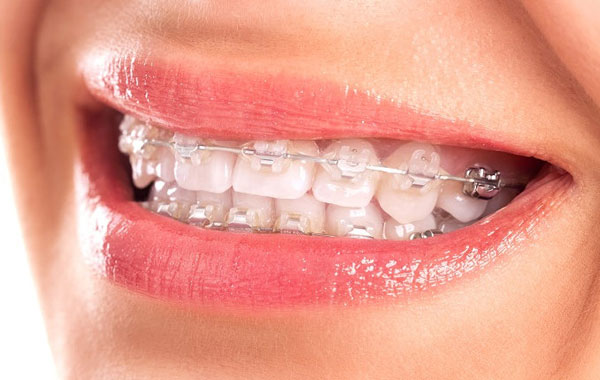 Thời gian niềng răng mắc cài sứ dây trong thường kéo dài từ 12 - 24 tháng