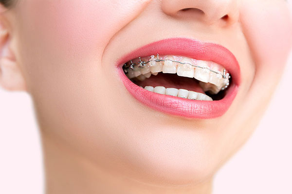 Niềng răng mắc cài sứ tự đóng là phương pháp chỉnh nha cải tiến