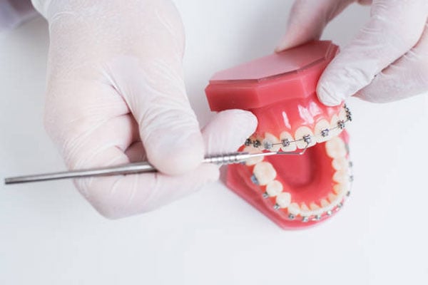 Niềng răng kết hợp 2 hàm sẽ có hiệu quả cao hơn, do lực kéo mạnh mẽ, đều và ổn định