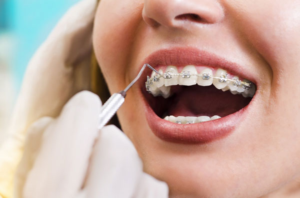 Niềng răng mắc cài kim loại dây thẳng là một trong những phương pháp chỉnh nha được ưa chuộng