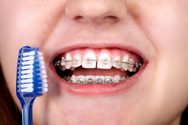 Lưu ý quan trọng sau khi niềng răng sứ và kim loại để duy trì răng khỏe đẹp